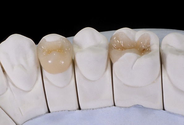 Model showing repairs to damaged teeth