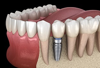 Animated implant supported replacement tooth
