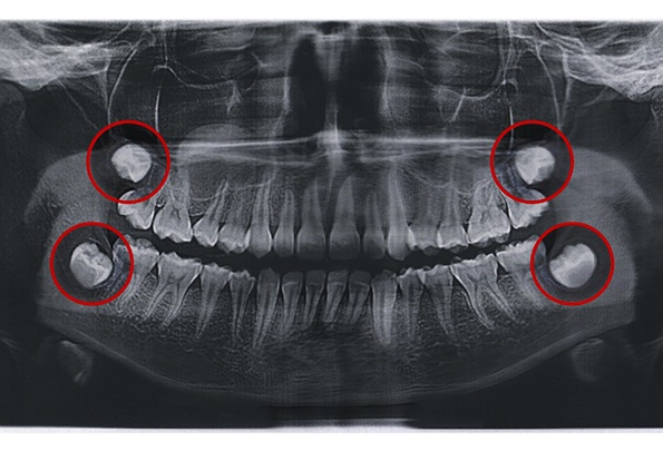 X-ray with wisdom teeth circled in red
