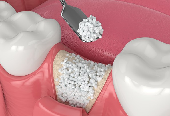 diagram of an advanced implant procedure in Everett