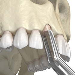 diagram of a bone graft in Everett