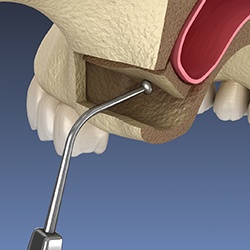 image of sinus lift