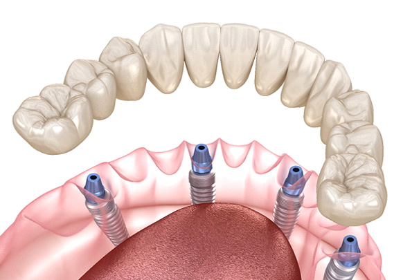 Digital illustration of All-On-4 dental implants