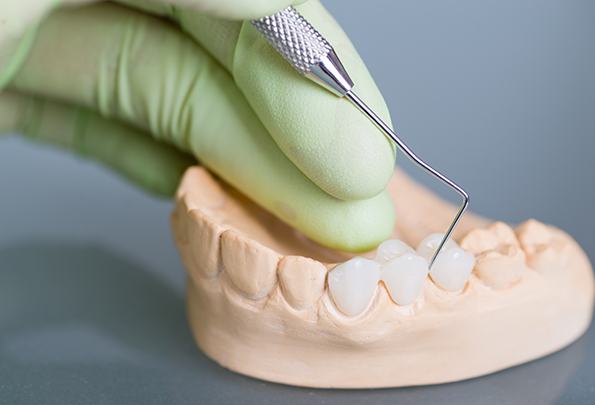 Dental bridge in Everett sitting on a mouth mold