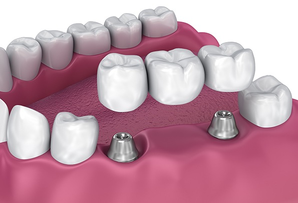 Digital image of an implant bridge