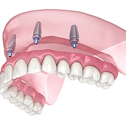Implant dentures in Everett