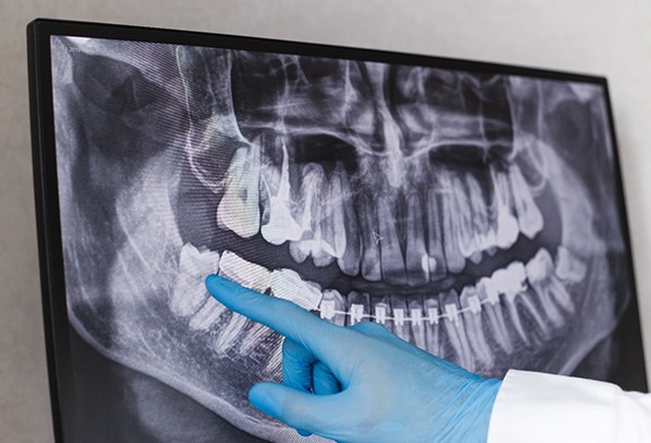 Emergency dentist in Everett pointing at an X-ray