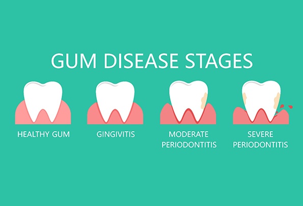 illustration of gum disease for tooth extractions in Everett