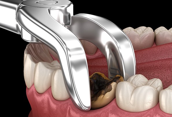 illustration of decayed tooth extraction in Everett