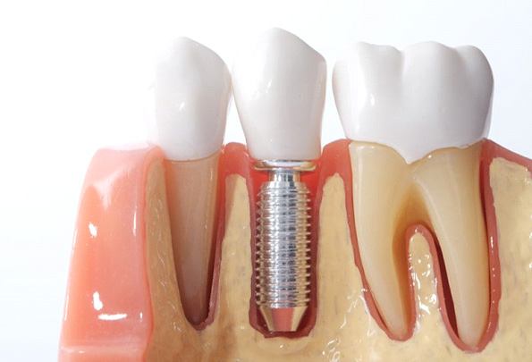 a plastic model of a dental implant