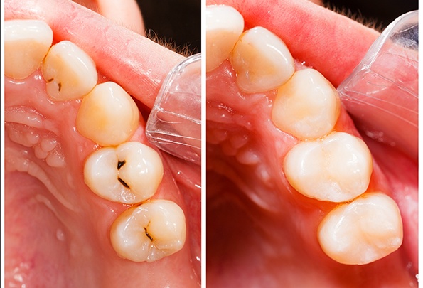 before and after images side-by-side from a patient that received a cavity filling