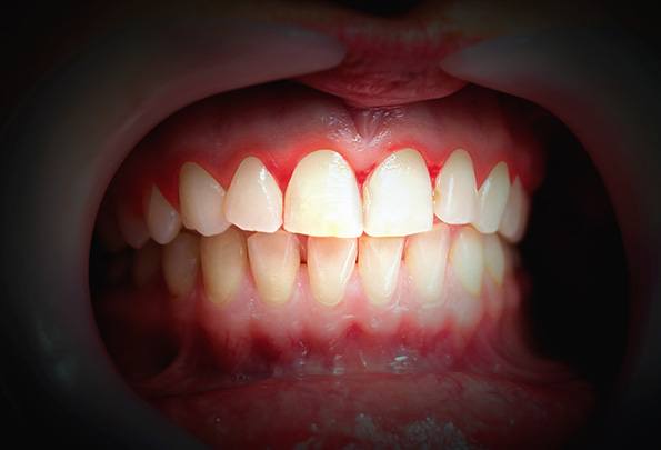 Symptoms of gum disease include red, swollen gums