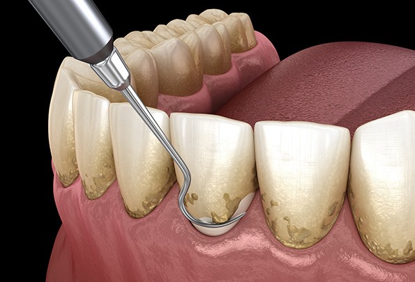 Scaling and root planing can remove hardened deposits of oral bacteria 