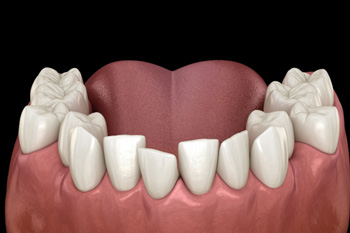 Illustration of crowded teeth