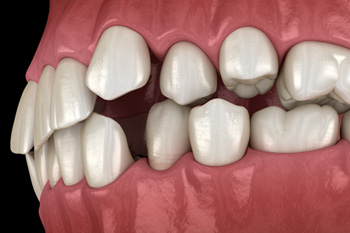 Illustration of gapped teeth
