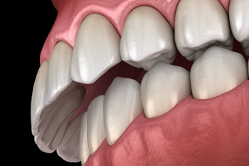 Illustration of an overbite