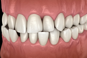 Illustration of a crossbite