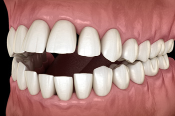 Illustration of an open bite