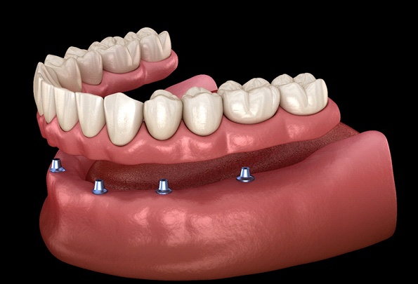 A digital image of 6 dental implants surgically placed along the lower arch and an implant denture placed on top