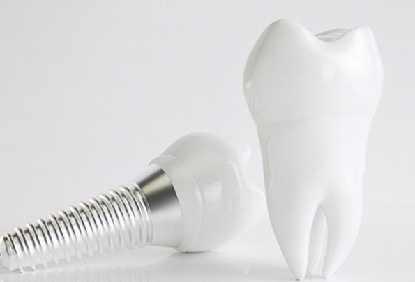 An image of a single tooth dental implant next to a model of a tooth