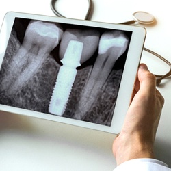 Dentist holding tablet showing X-ray of dental implant in Everett