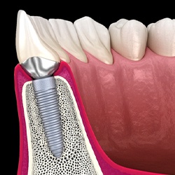 Diagram showing how dental implants work in Everett