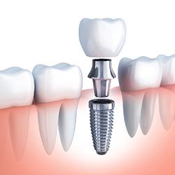 diagram of a dental implant placed with guided implant technology