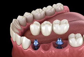 Animated implant supported fixed bridge