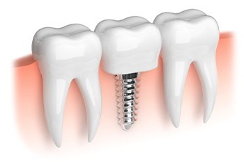 Animated mini dental implant supported tooth