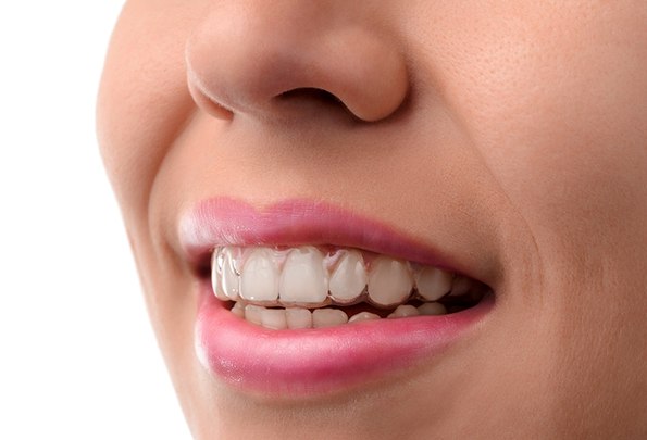 An up-close image of a person wearing an Invisalign aligner over their top row of teeth