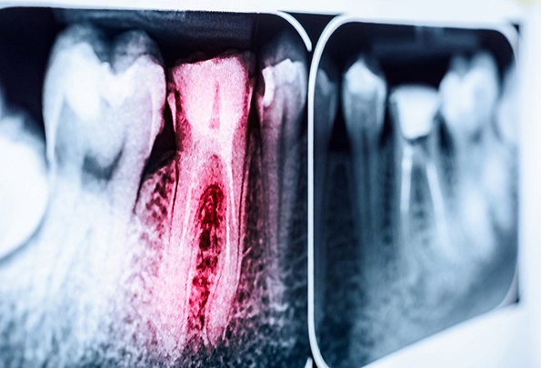 an X-ray of a tooth that needs root canal therapy