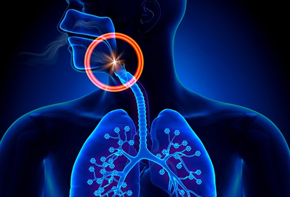 Illustration of the airway being blocked due to sleep apnea