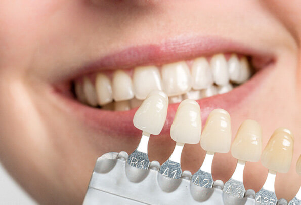 closeup of a shade guide being held to someones smile