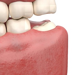 3D render of an impacted wisdom tooth