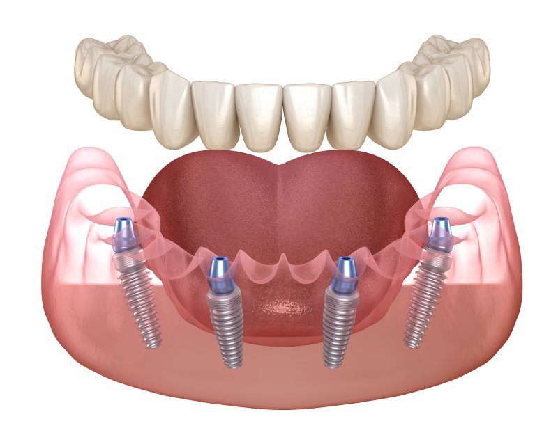 Illustration of dentures and implants for All-on-4