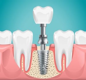 Image of dental implant placement surgery.