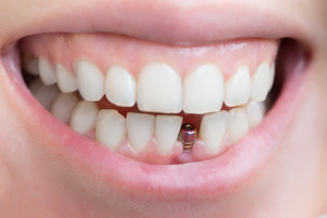 The smile of someone with a dental implant