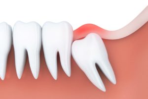 Model of impacted wisdom tooth